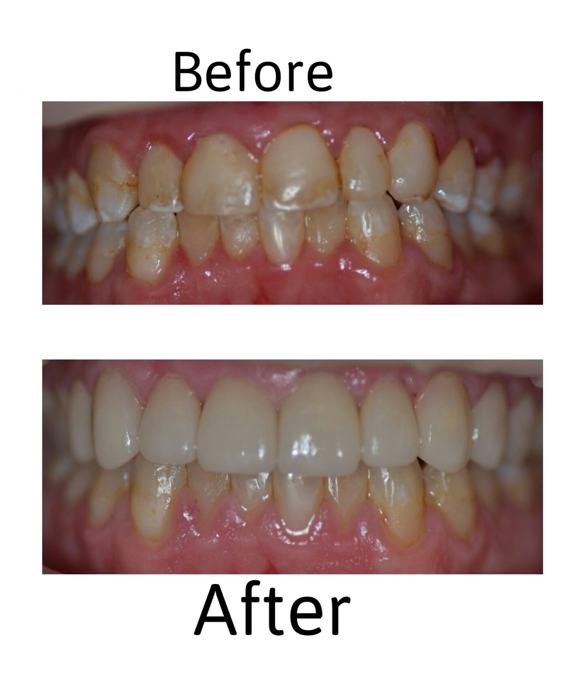 Enclave Dental Offers No Prep Veneers In Southlake Enclave Dental ...