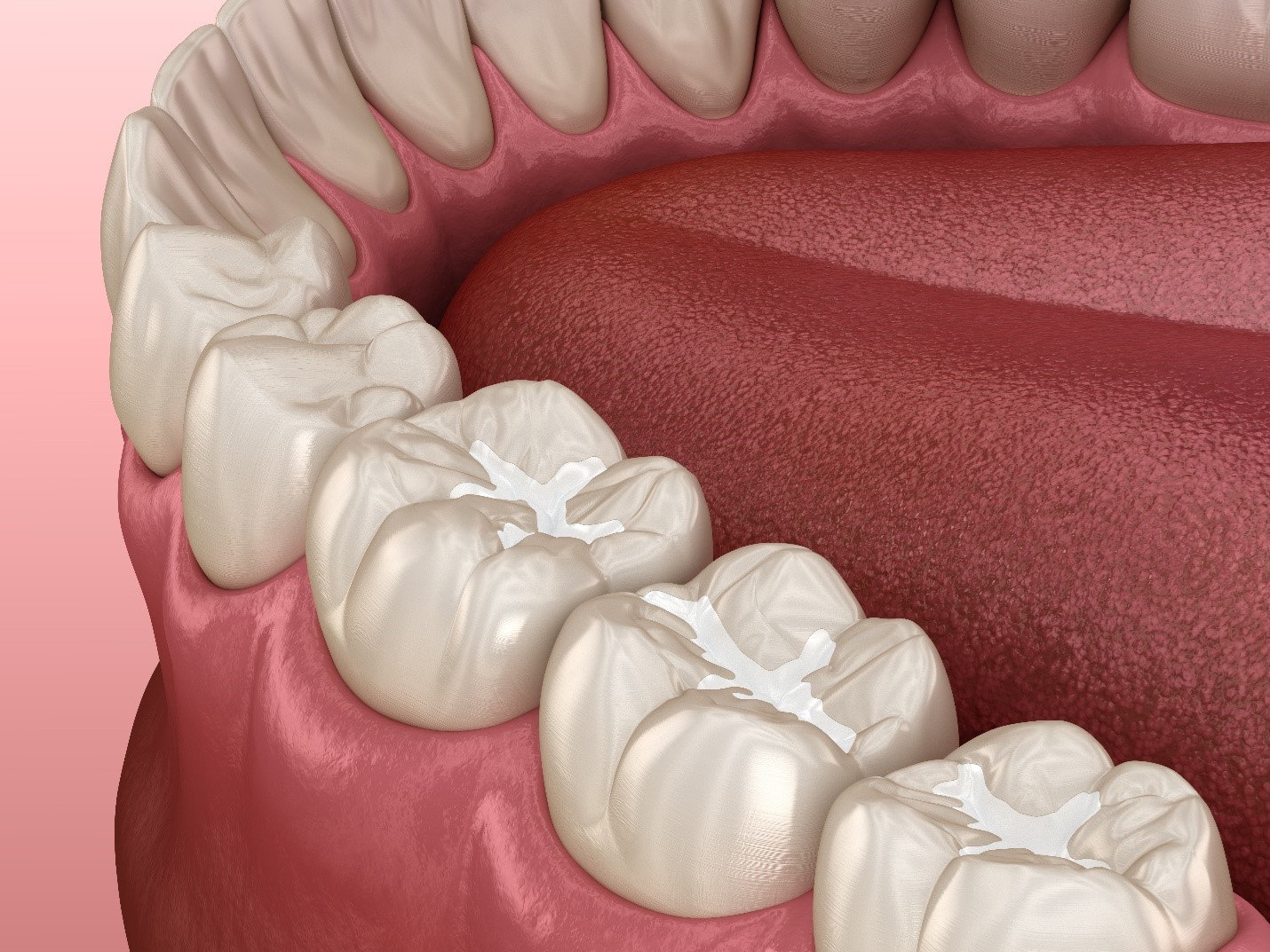 Illustration Of Biocompatible Fillings In Southlake On Bottom Teeth Enclave Dental Preetha