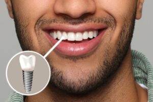 Man’s smile with dental implant in the upper arch